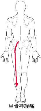 椎間板 膨隆 腰椎 と ヘルニア